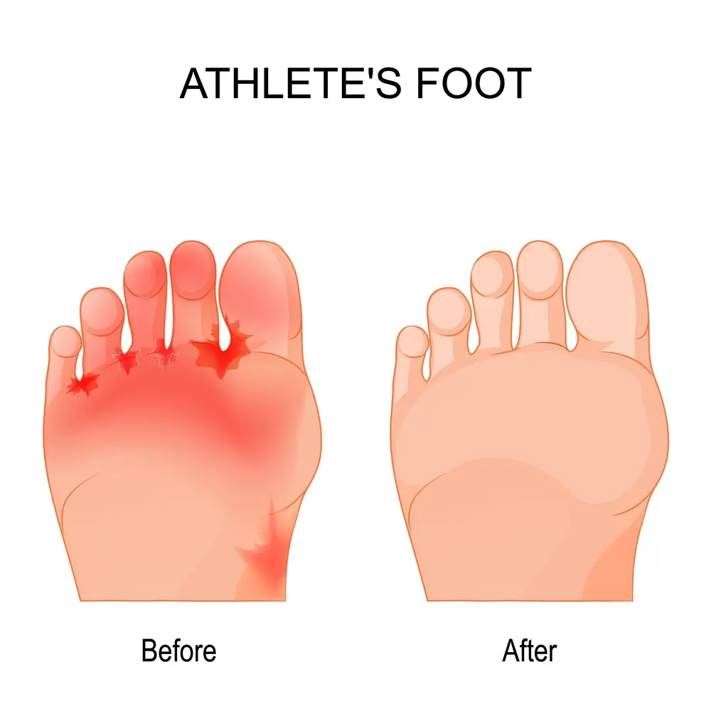 How to Apply the Spray Effectively on Athlete’s foot
